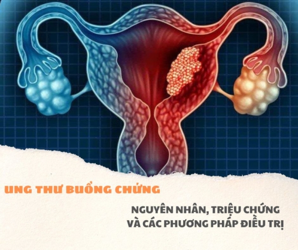 Ung thư buồng trứng: Nguyên nhân, triệu chứng và các phương pháp điều trị